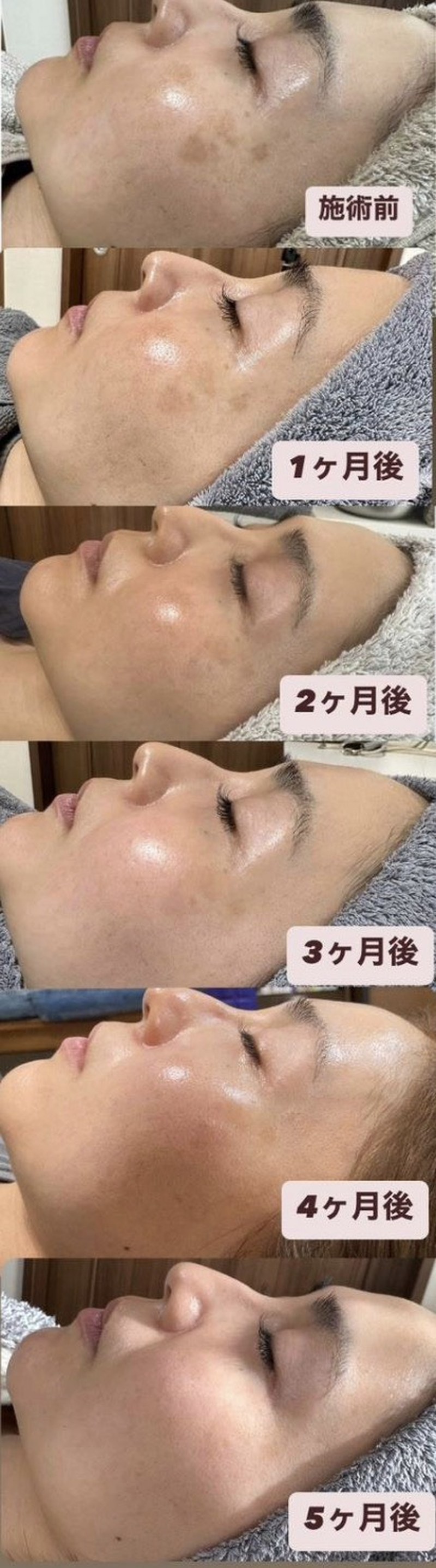 40代女性の5ヶ月間の肌の経過